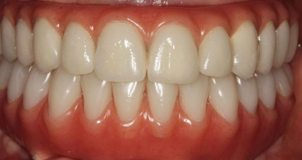 Benefits of All On 4 Dental Implants