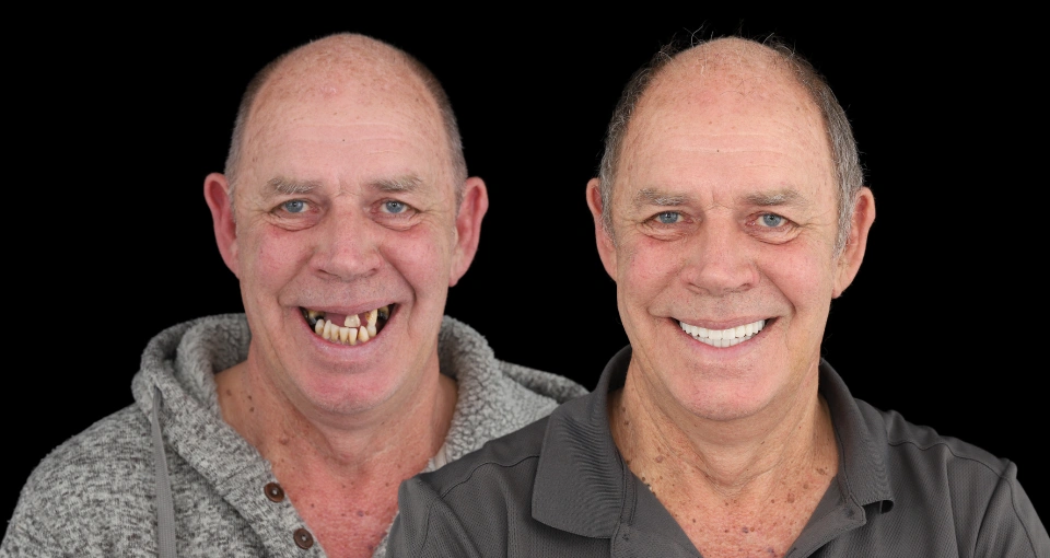 Perth Dental Implant Centre All On 4