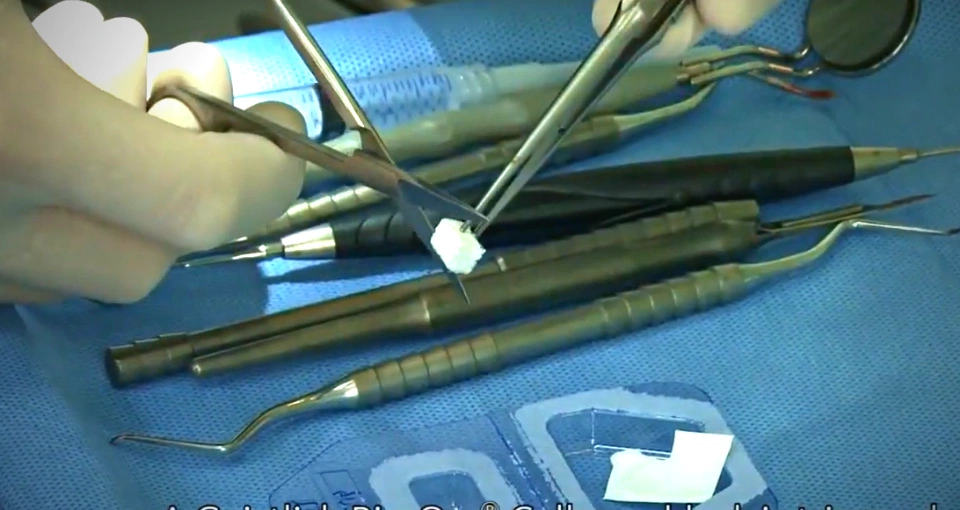 Why might you need bone grafting? Why might you need bone grafting?