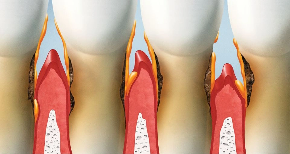 Living with Gum Disease