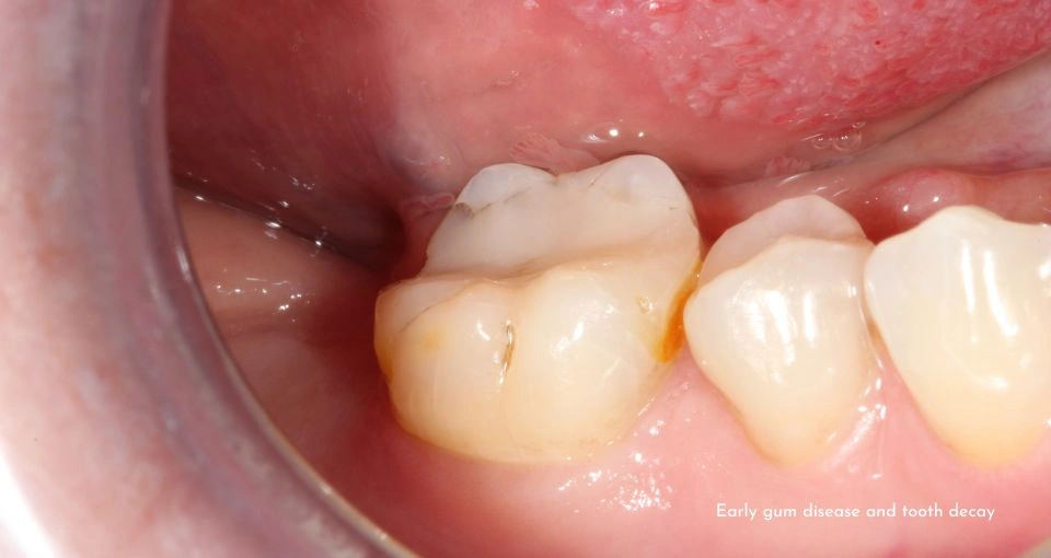 Mild gum disease