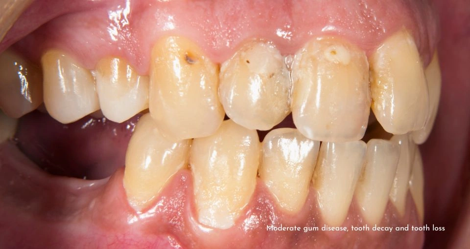 Advanced gum disease