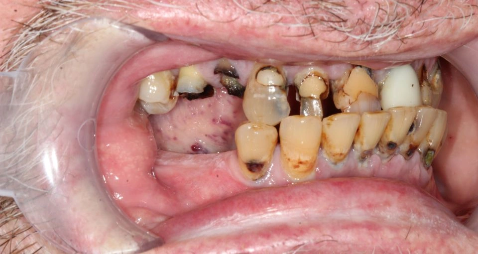 Advanced gum disease