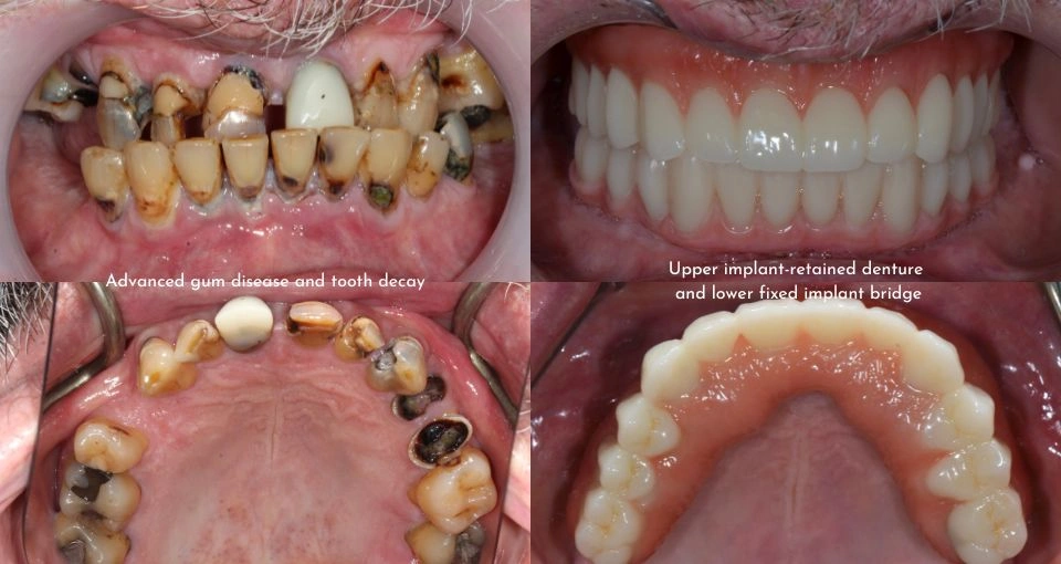 How does gum disease affect dental implants?