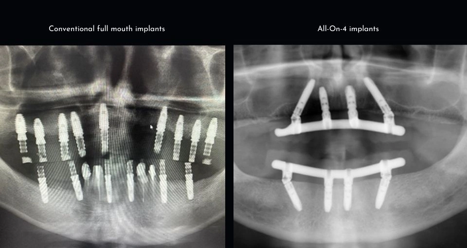 All-on-4® vs other dental implants All-on-4® vs other dental implants