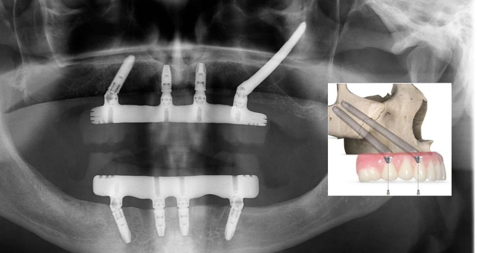 Implant surgery