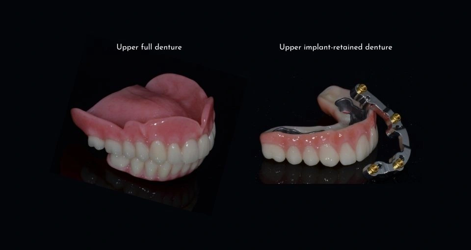 What are the alternatives to All-On-4® dental implants?