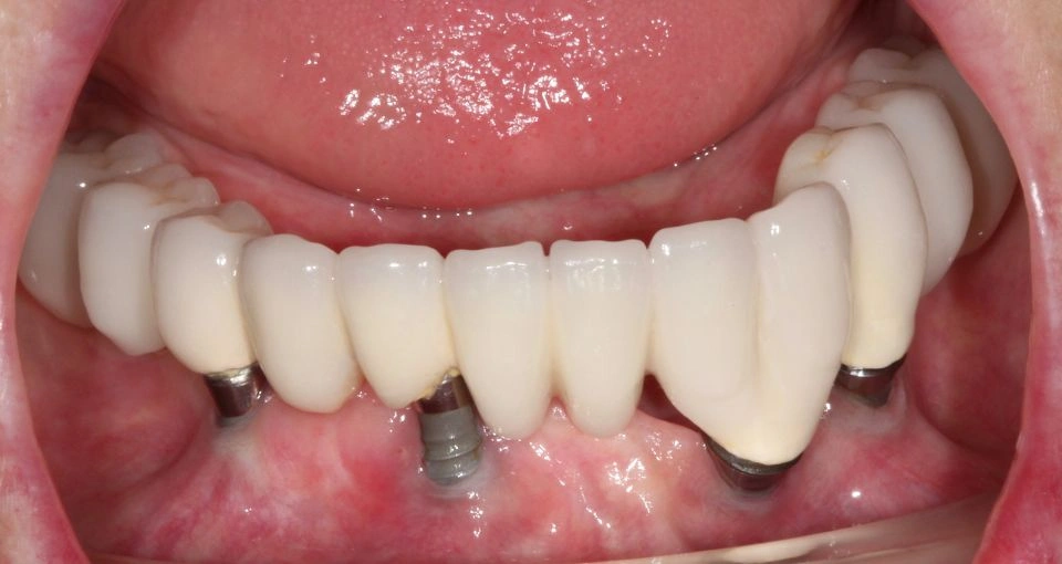 What are signs of implant complications?