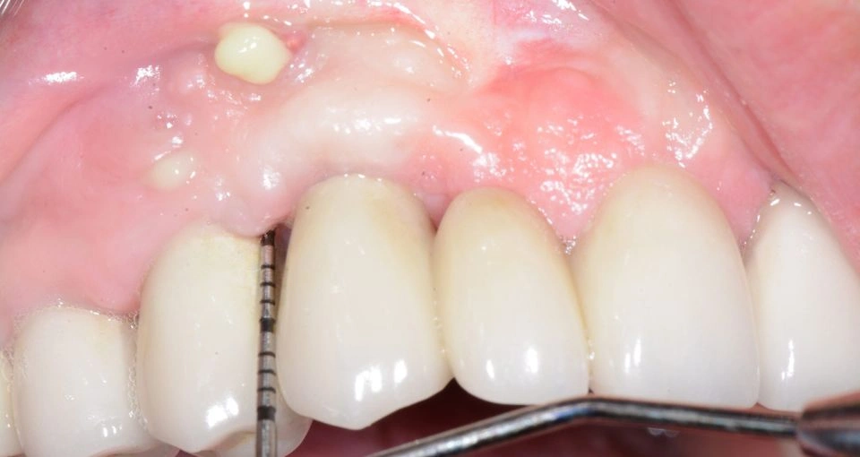 Why do some implants fail?