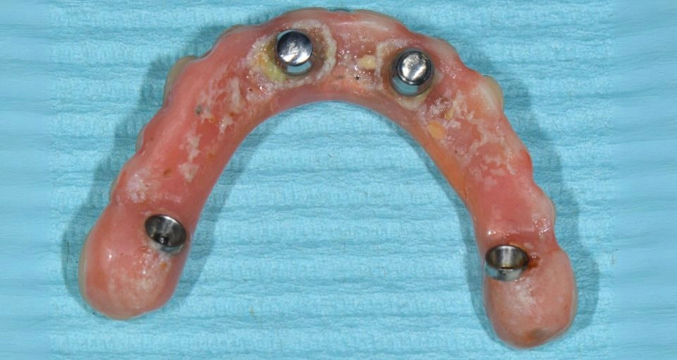 How are implant complications treated?