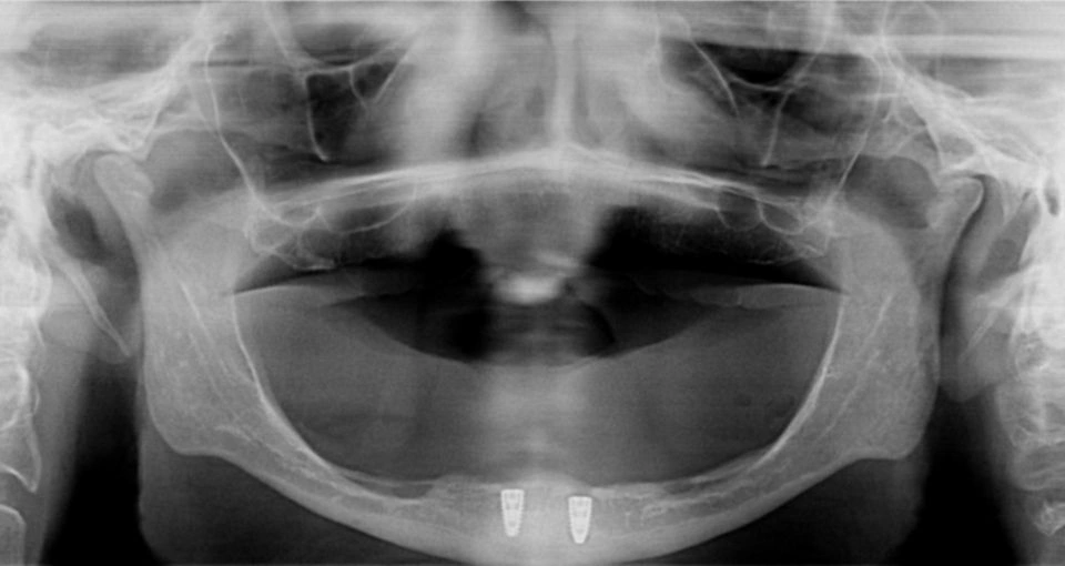 How are implant complications treated?