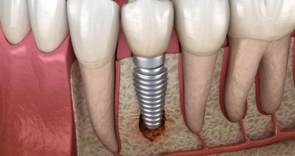 How are implant complications treated?