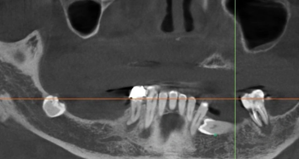 What causes bone loss around teeth?