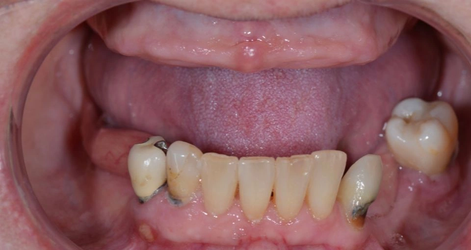 Tooth loss or extraction