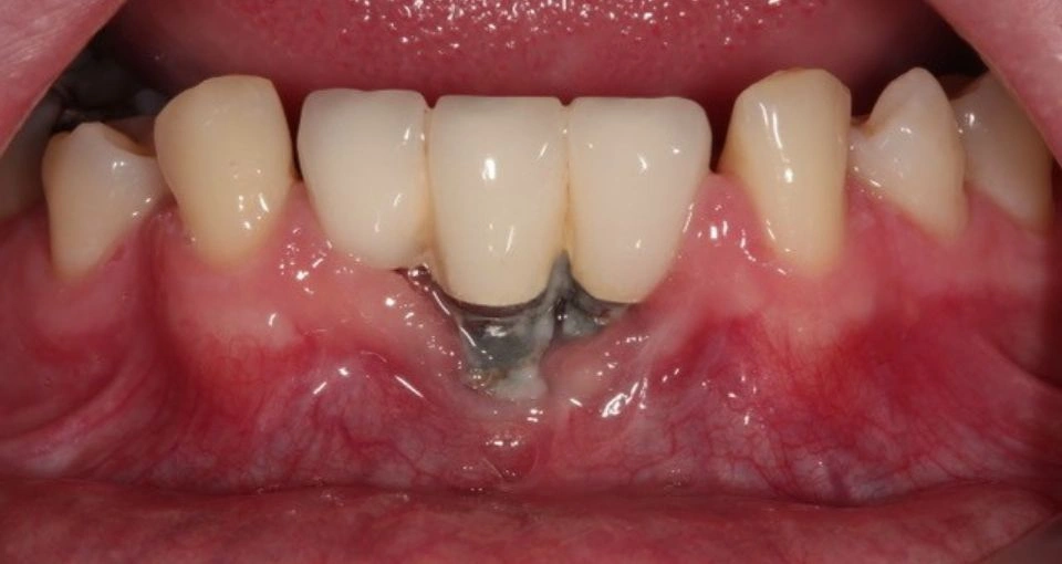 Gum disease and peri-implantitis