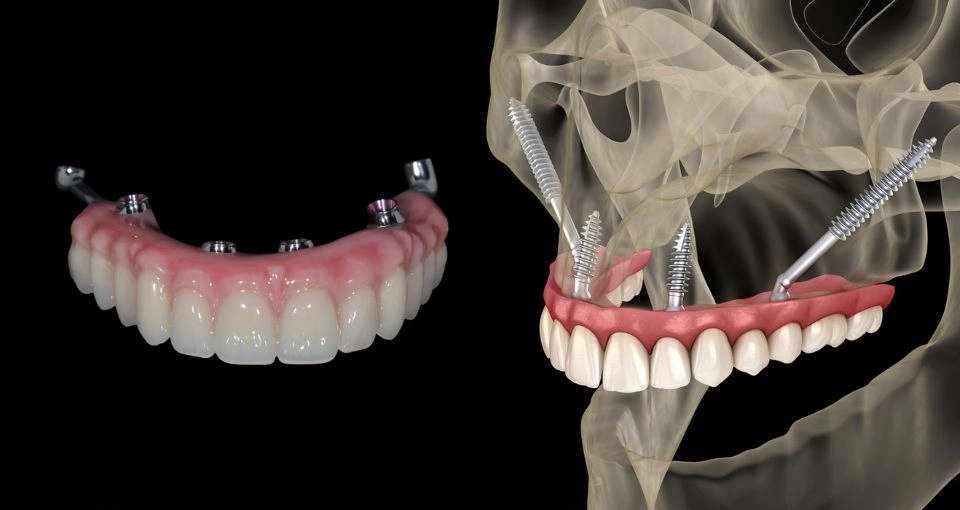 Additional dental implants