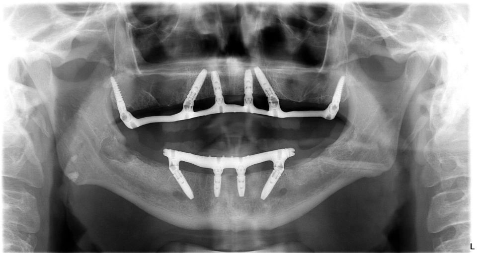 Pterygoid implants