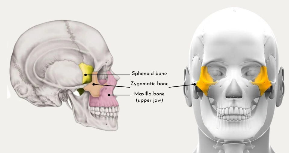 Pterygoid implants