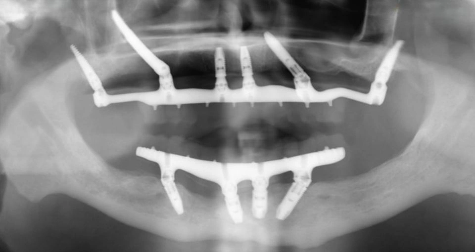 All-on-4® dental implants in Perth