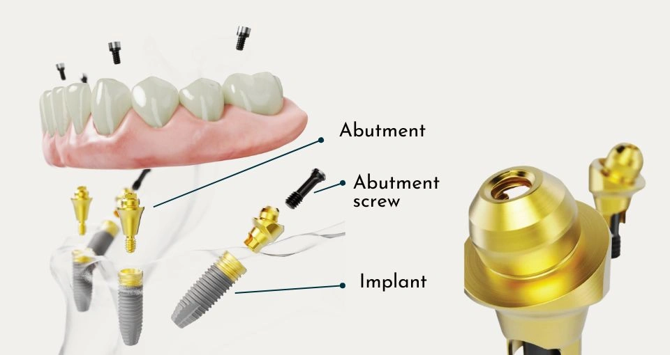 How All-on-4® implants work How All-on-4® implants work
