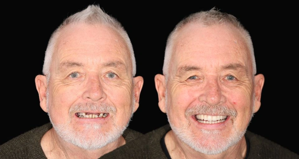 Does age affect suitability for All-on-4®?
