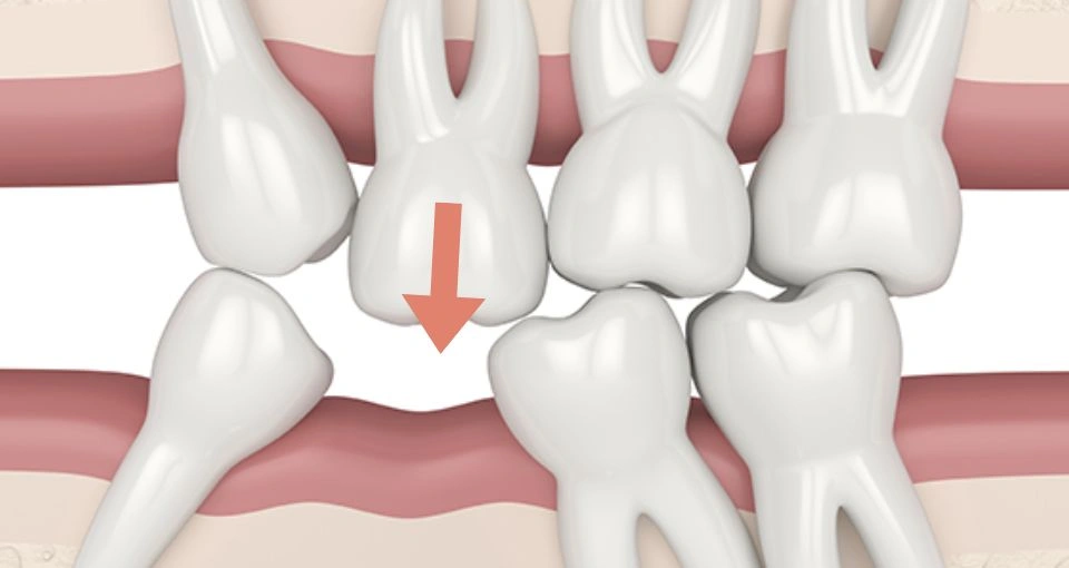Prevents Shifting of Teeth