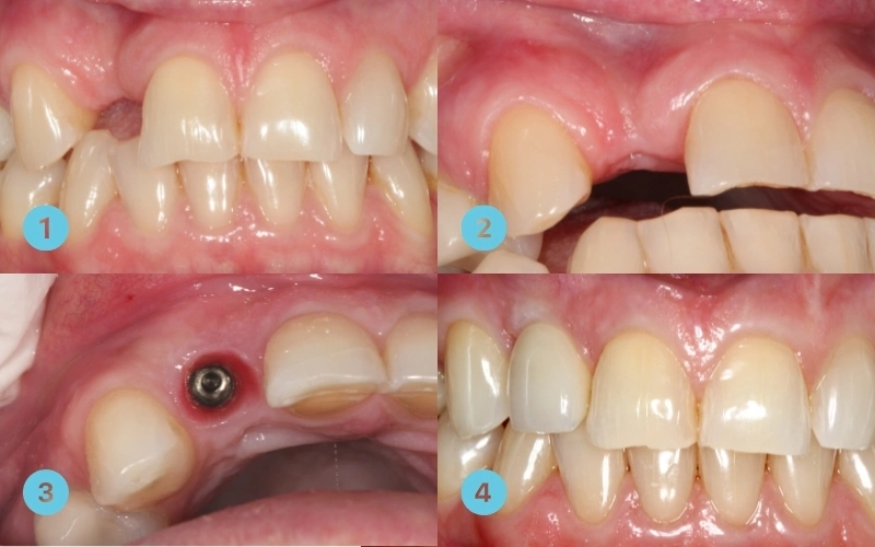 Bone Grafting for Dental Implants