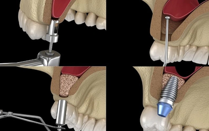 Sinus Lifts for Dental Implants
