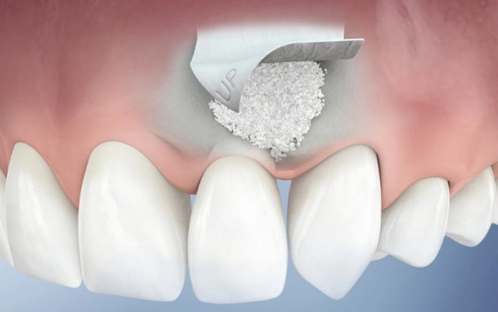 Bone Graft Materials