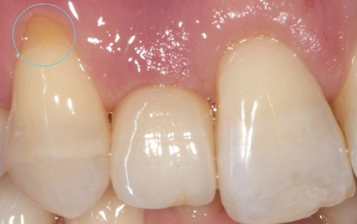 Gum Grafts for Better Aesthetics