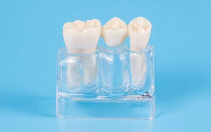 What is a Dental Bridge?
