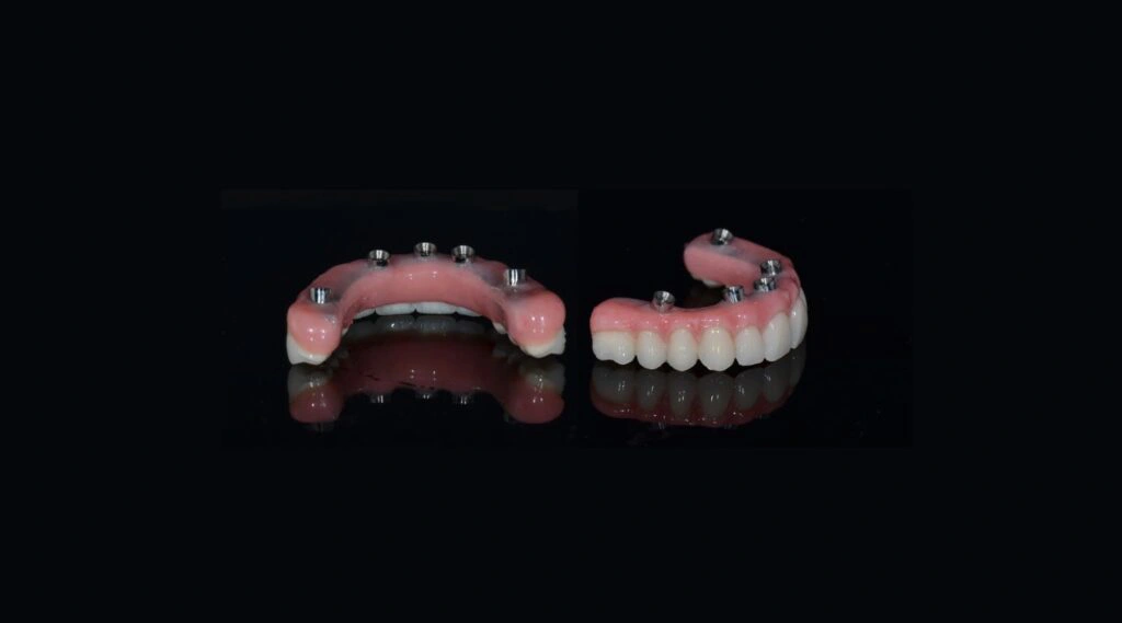 The Ultimate Guide to All-On-4® Dental Implants