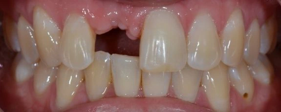 Single-dental-implant-1-Before