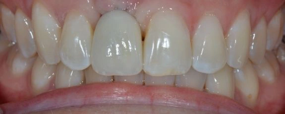 Single-dental-implant-1-After
