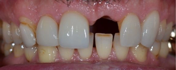 Single-dental-implant-2-Before