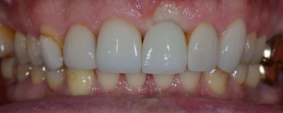 Single-dental-implant-2-After