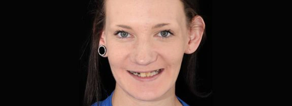 Lower-All-On-4-Upper-Denture-before