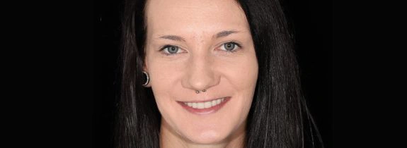 Lower-All-On-4-Upper-Denture-after