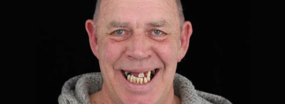 All-On-4-Dental-implants-before