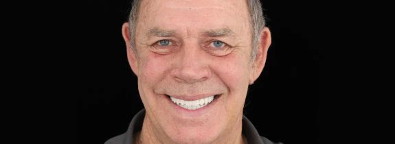 All-On-4-Dental-implants-after