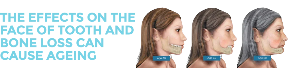 Consequences of Tooth Loss Consequences of Tooth Loss