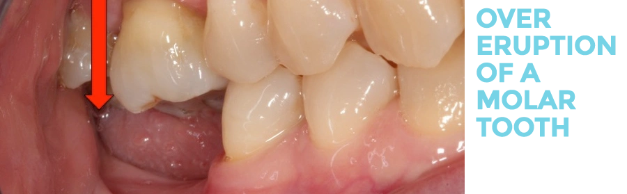 Consequences of Tooth Loss Consequences of Tooth Loss
