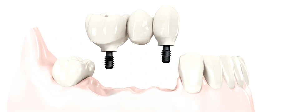 Several Missing Teeth