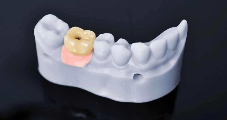 Why Choose Dental Implants?
