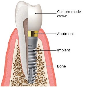 The Goal of Implant Placement