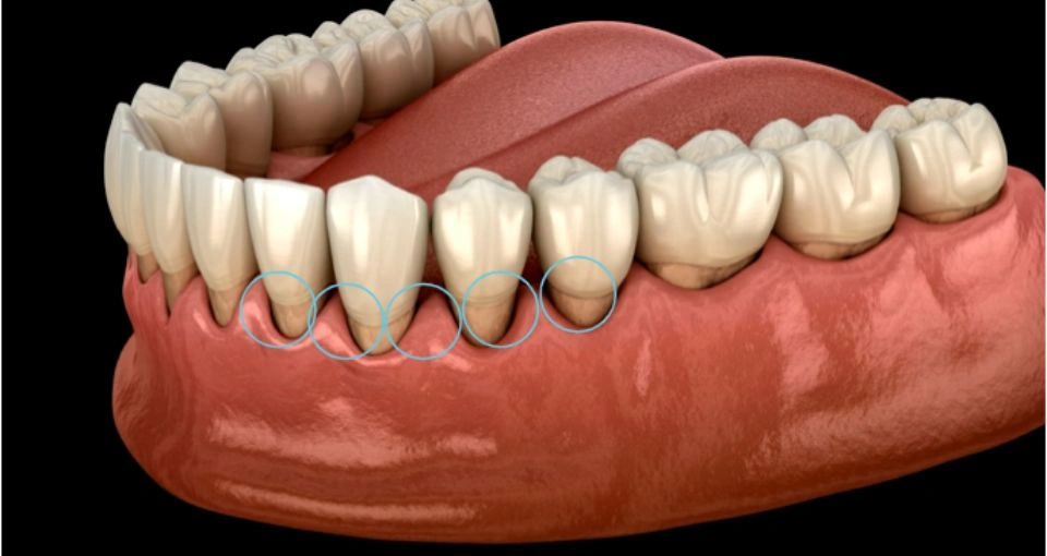 How do I know if my gums are receding? How do I know if my gums are receding?