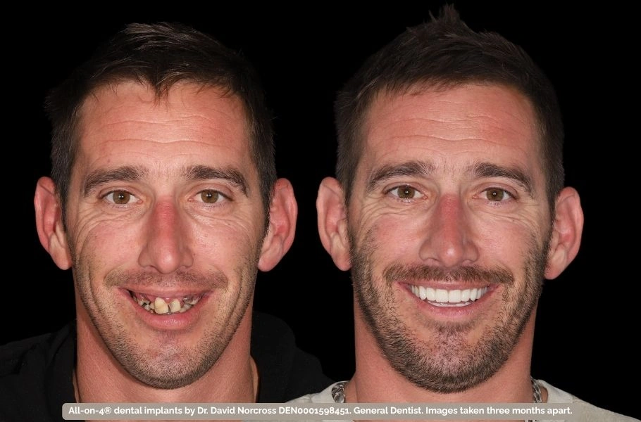 Full Arch Dental Implants
