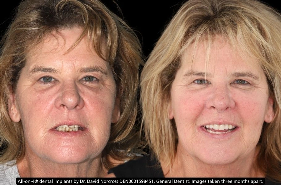 Pterygoid-implants