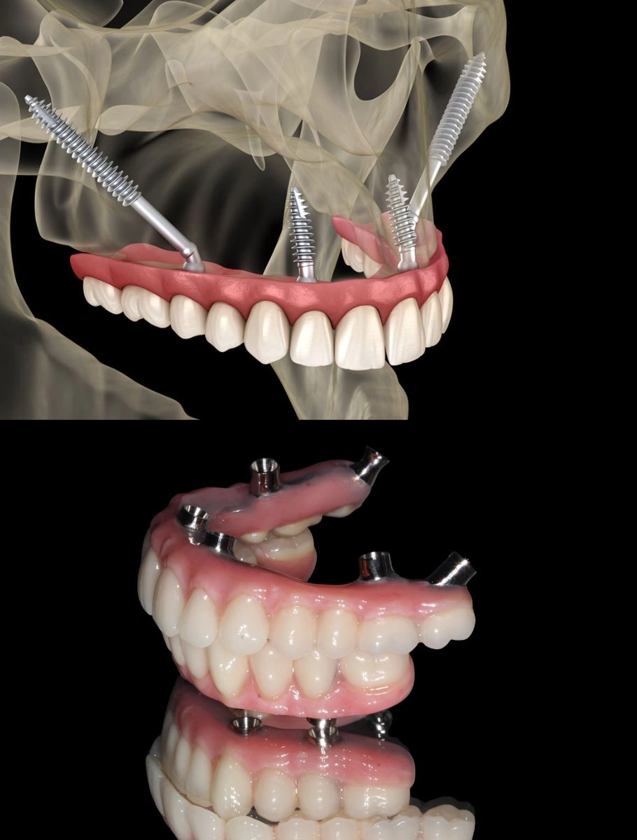 Longer-implants-All-on-4