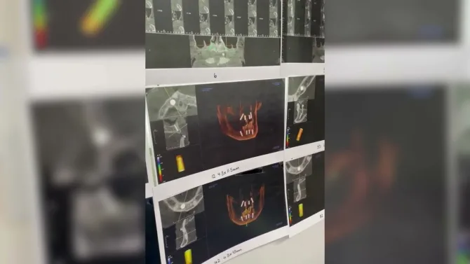All-on-4® Implants